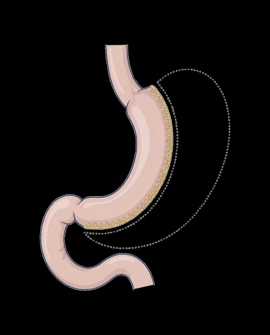 Illustration : Sleeve gastrectomie